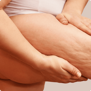 Chub rub caused by lack of anti-chafing underwear